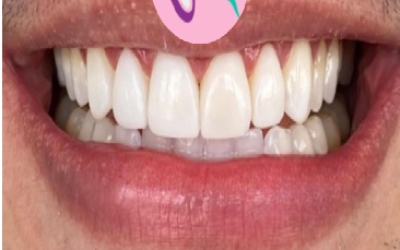 Depois - Clareamento