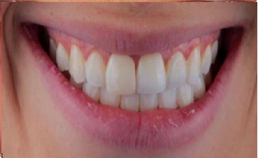 Antes - Lentes de Contato