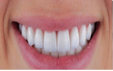 Depois - Lentes de Contato