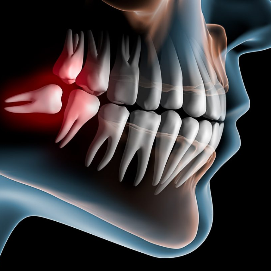 Extração de Siso - NEOdonto Odontologia em Goiânia