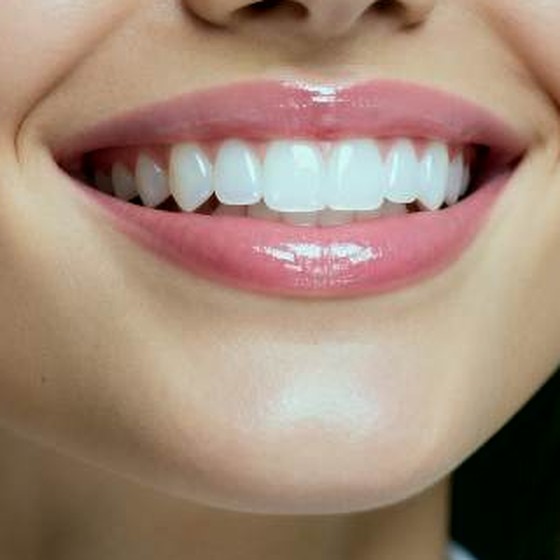 Facetas de resina - sorriso com dentes esteticamente alinhados